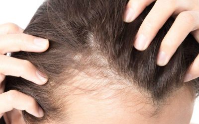 How to prevent hair loss with hydrolyzed collagen.